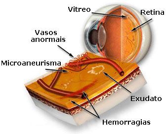 Doenças da Retina